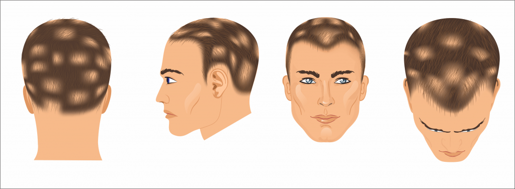 Medication Induced Hair Loss L Parsa Mohebi