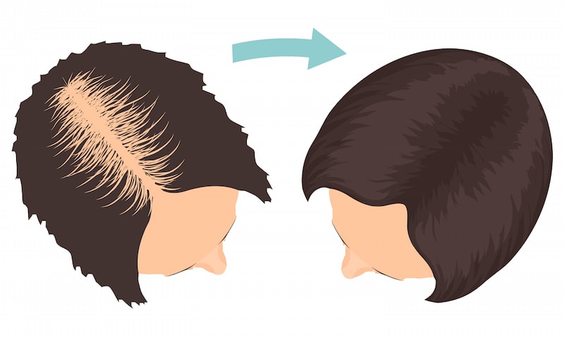Woman Hair Transplant After a procedure