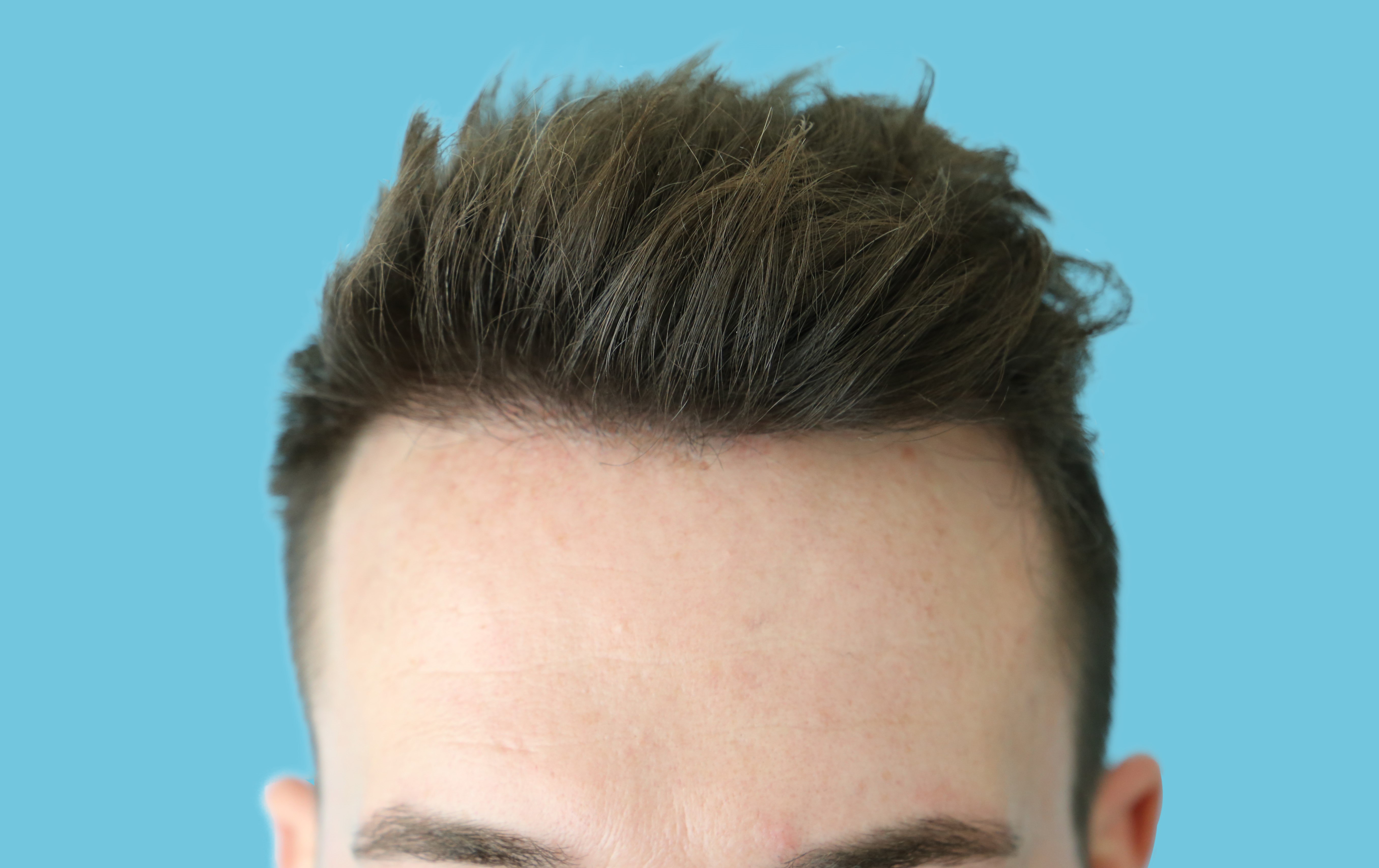 4. Fine Blonde Hair Transplant Before and After - wide 4