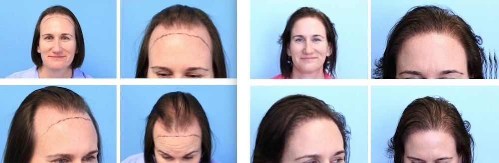 Image result for Female Hair Transplant