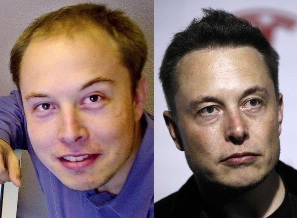 Elon-Musk-Hair-Transplant.jpg