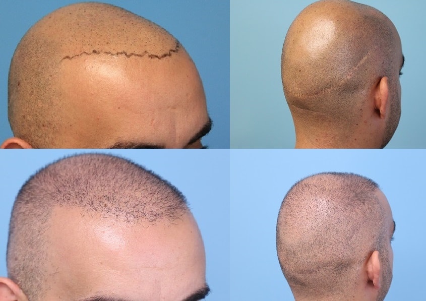 Patient After A Traditional Strip Procedure With A Linear Scar On Donor