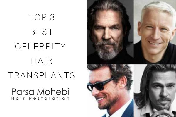 Top 3 Best Celebrity Hair Transplants