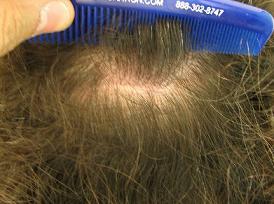 Hair Transplant Scar Revision