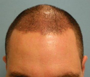 Post FUE Hair Transplant perfromed at Mohebi Medical, US Hair Restoration Center