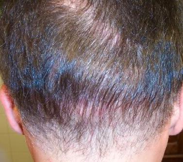 Nape Hair at the back of the neck is not optimum for hair restoration.