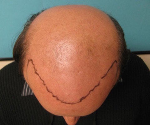 advanced-hair-loss-top-view