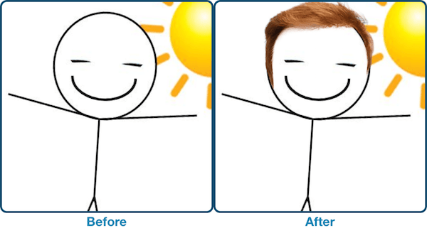 Before and after hair transplant: Picture was created by App: Hair Now