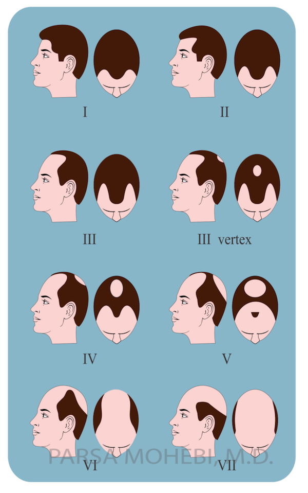 Men's Hair Loss Classification