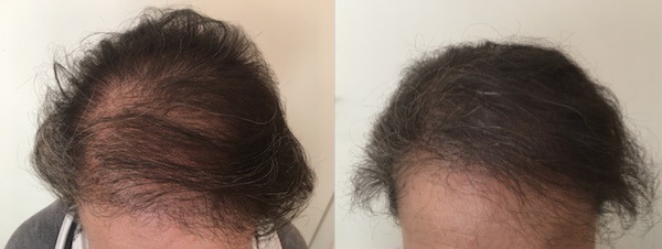 Scalp Micro Pigmentation for female