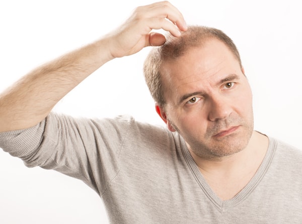 Male hair loss class shown