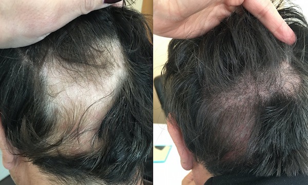 Scalp Micro Pigmentation for Alopecia