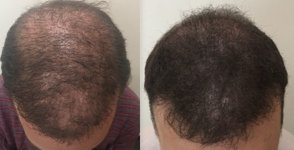 Scalp Micropigmentation | Parsa Mohebi - Parsa Mohebi Hair Restoration