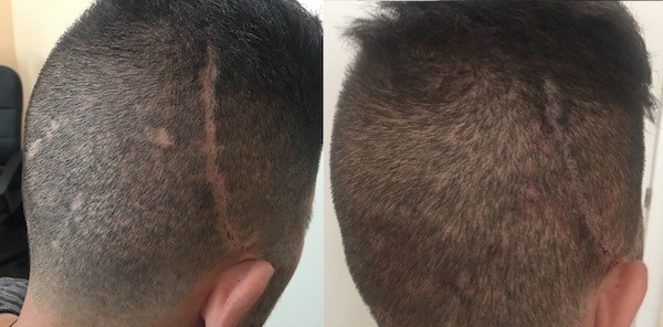 Scalp micropigmentation