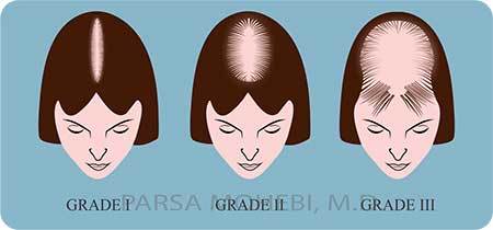 Female Hair Loss Grades