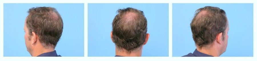 Immediately after the Celebrity FUE procedure