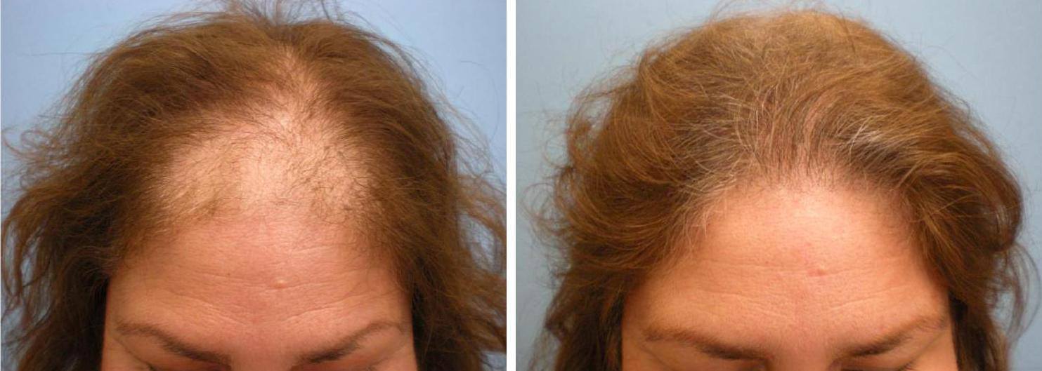 Severe Hair Loss