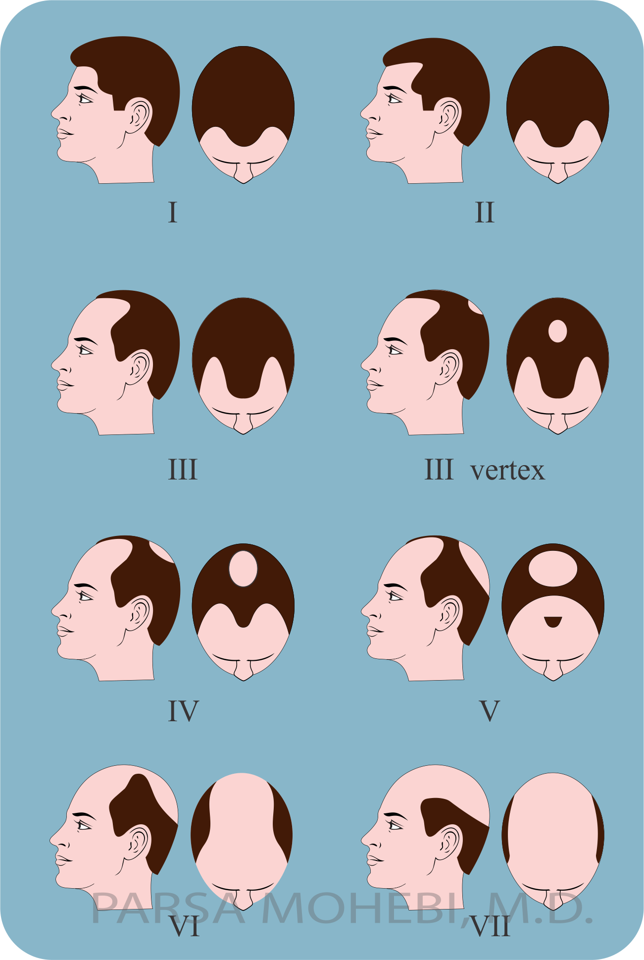 male baldness pattern 2 | Parsa Mohebi - Parsa Mohebi