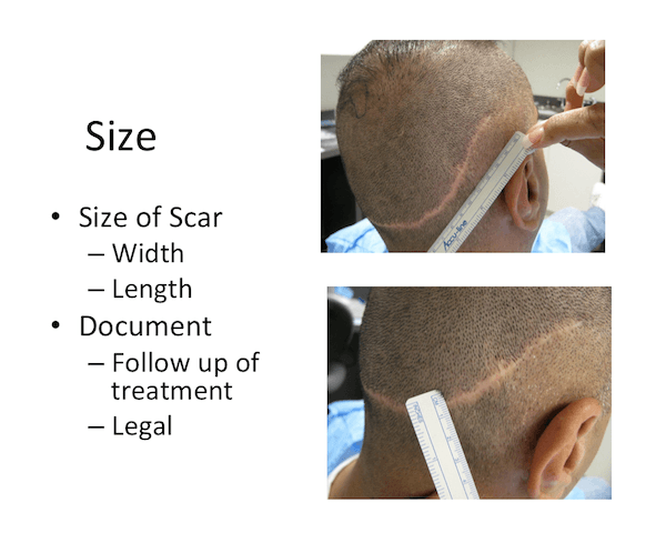 Scare after Hair Transplant