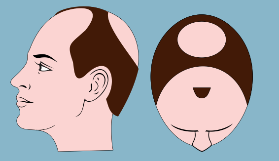 Hair Transplant Before & After Photos