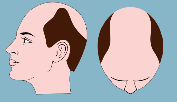 Hair Transplant Before & After Photos