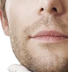 Beard-to-Scalp-Hair-Transplant