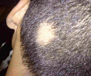 Alopecia Areata