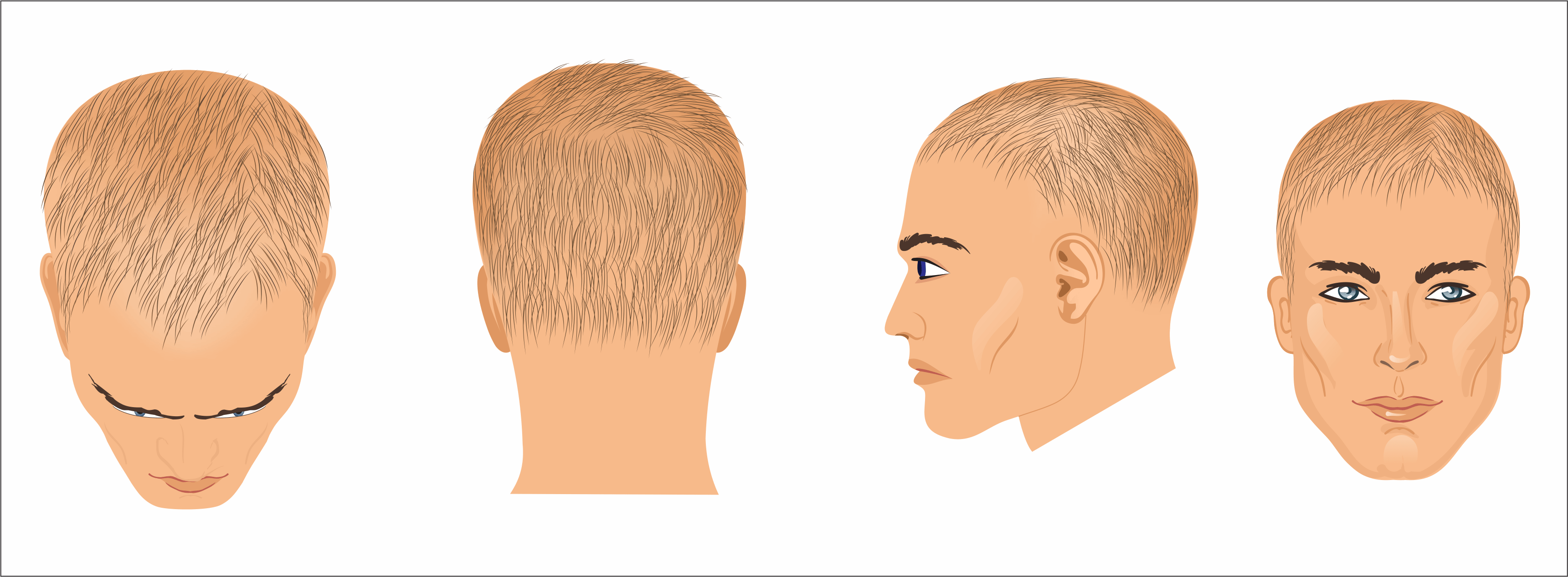 Recovering from hair loss caused by telogen effluvium 