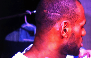The back of Lebron’s head displaying a clear strip-harvest surgery scar