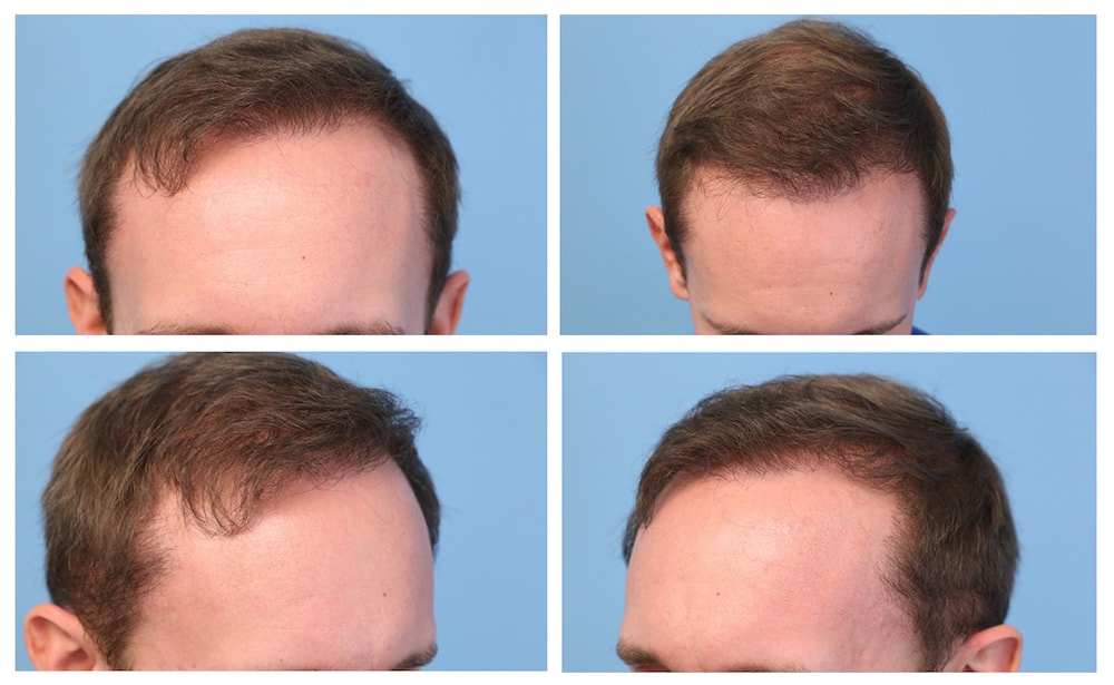 9 Months post hair transplant