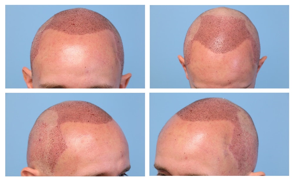Will I lose hair after a hair transplant? - Quora