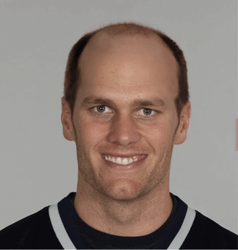 Hair loss Tom Brady