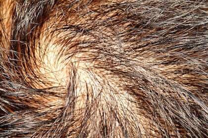 Possibly Hair Loss Treatment