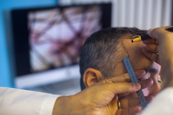 Hair Line Planning 