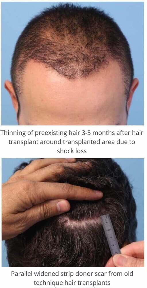 Thinning Hair And Wider Donor Scar After Hair Transplant Parsa