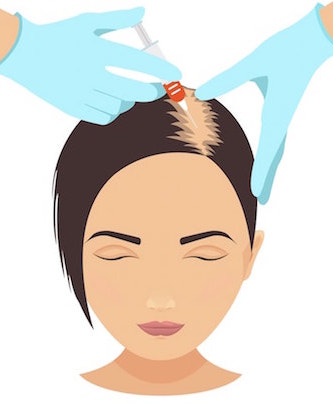 PRP Treatment for Womens Hair Loss