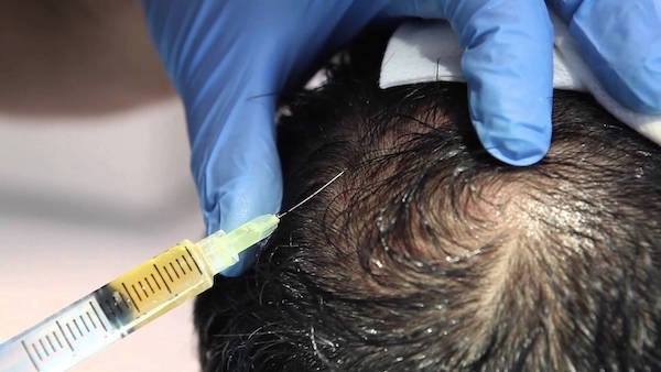 Platelet Rich Plasma Treatment for Hair Loss