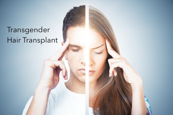 MTF Transgender Hair Transplant Surgery