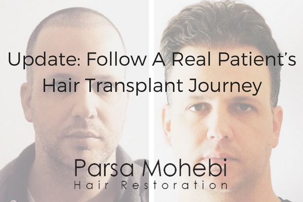 Parsa Mohebi Hair Restoration, real hair transplant journey