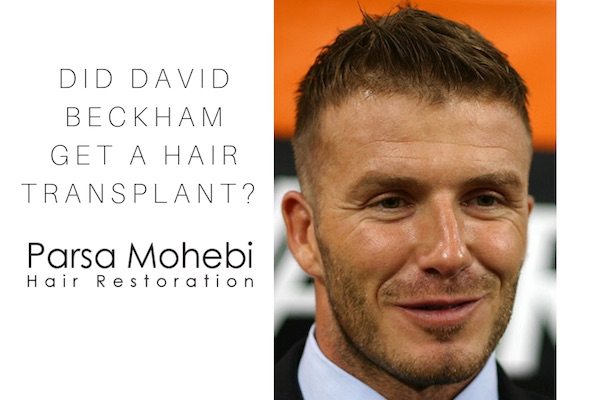 Did David Beckham have a hair transplant?
