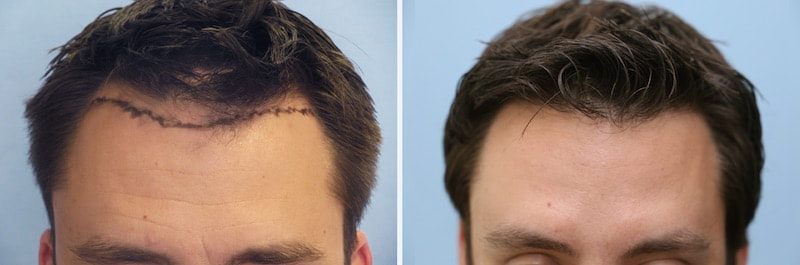 Perfect Hairline on a patient with male hair loss