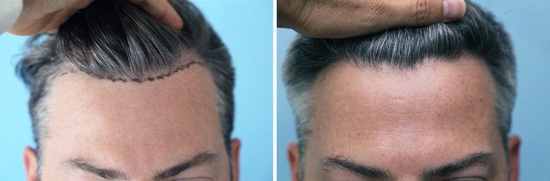 Power hairline for Dr. Parsa Mohebi's patient