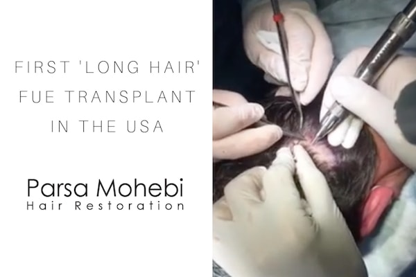 long hair transplant