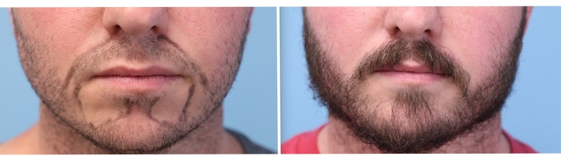 Beard Hair Transplant Results