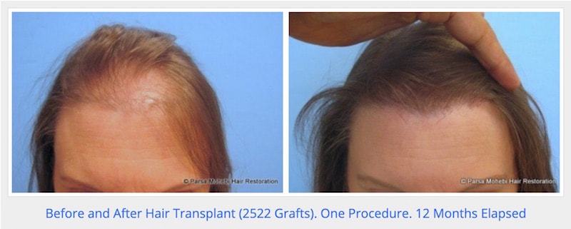 Female hair transplant before and after