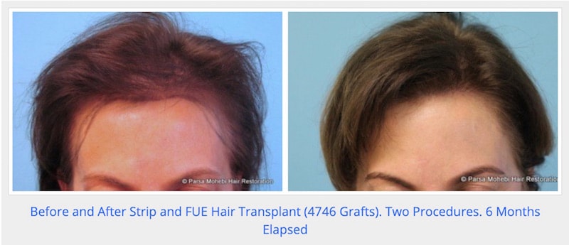 Before and After Female Hair Transplant