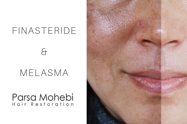 finasteride and melasma