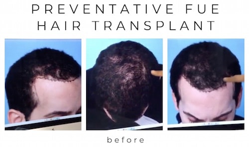 Preventative FUE hair transplant by Dr. Mohebi