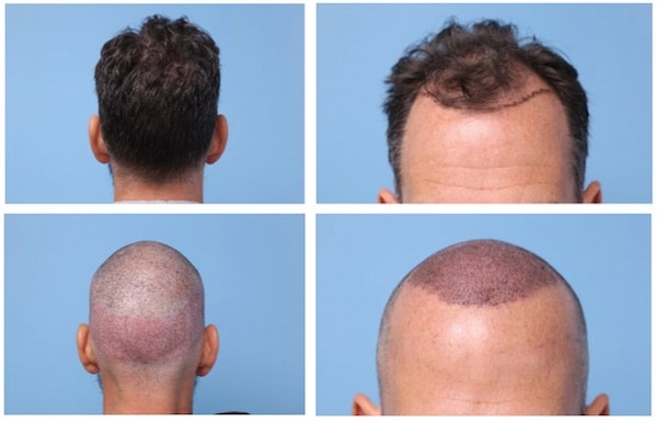 After hair transplant - shaved look