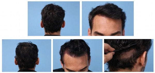 After layer shaving look for hair transplant